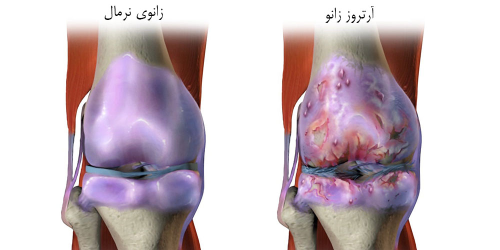 آرتروز مفصلی